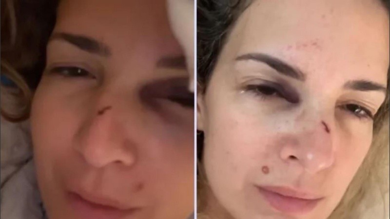 La actriz mostró el rostro con las lesiones