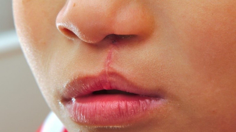 Esto se produce cuando las estructuras que forman el labio superior y el paladar no logran fusionarse adecuadamente durante el desarrollo embrionario.