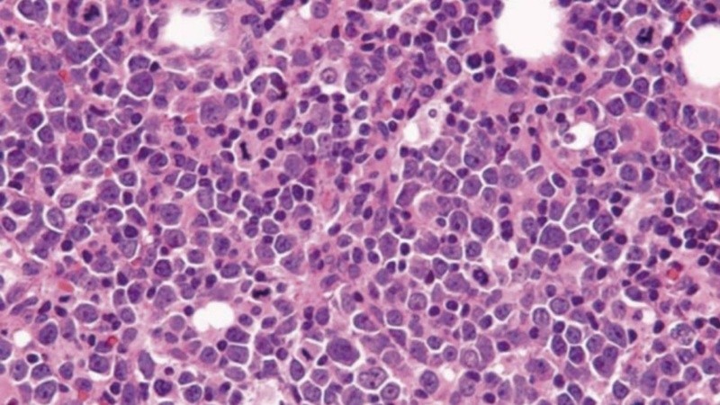 Tiene mayor frecuencia en varones mayores de 60 años y se caracteriza por una alteración genética específica.