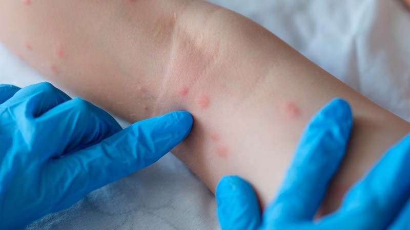 La detección del primer caso de la variante clado 1B de la viruela del mono en Argentina encendió las alertas en el sistema sanitario nacional.