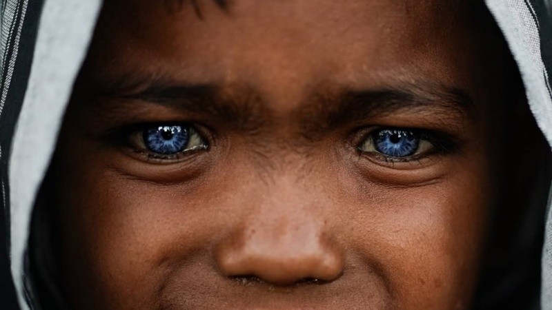 Con una prevalencia de aproximadamente un caso cada 40.000 personas, más comúnmente en poblaciones asiáticas y africanas, el síndrome se despierta durante la formación del embrión.