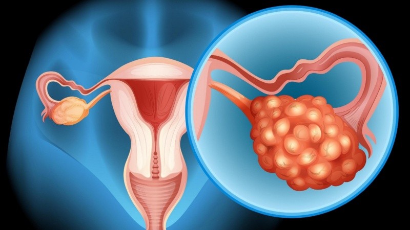El control ginecológico anual sigue siendo la herramienta más importante para actuar a tiempo, junto con estudios como la ecografía transvaginal y los análisis de marcadores tumorales.