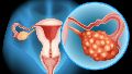 El control ginecológico anual sigue siendo la herramienta más importante para actuar a tiempo, junto con estudios como la ecografía transvaginal y los análisis de marcadores tumorales.