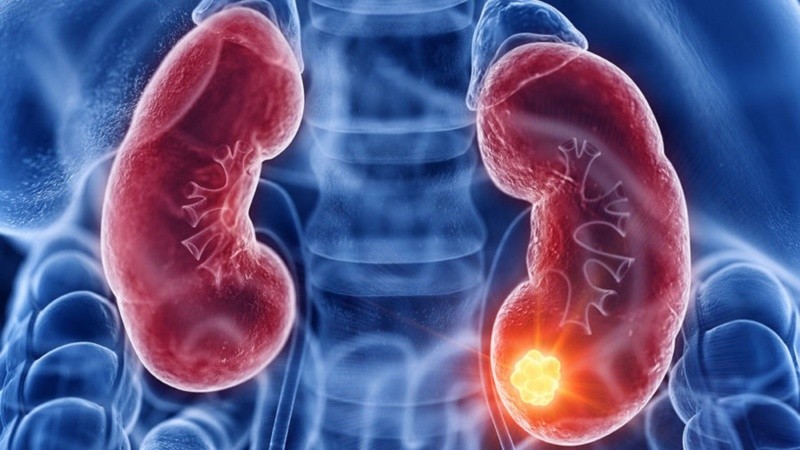En Argentina es el quinto cáncer más frecuente y representa casi el 4% de los diagnósticos oncológicos.