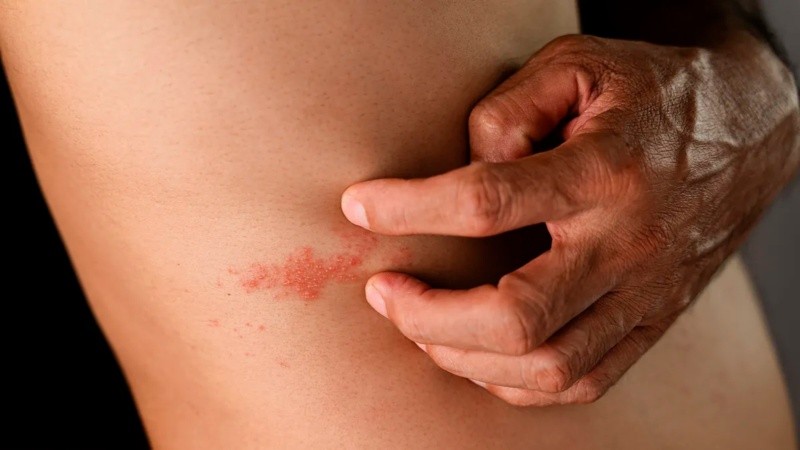 El herpes zóster, conocido popularmente como culebrilla, es una de las infecciones a atender con especial cuidado si existe riesgo cardiovascular.