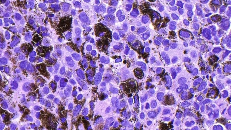 Una vacuna experimental de ARNm redujo el riesgo de que el melanoma reapareciera en un 42% (Foto: Ziad M. El-Zaatari/Science Photo Library/Getty Images)